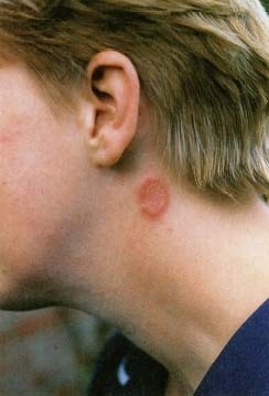 What You should Know About Ringworm - WebMD
